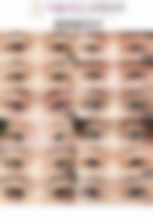 达芬奇不开刀去眼袋成效如何？