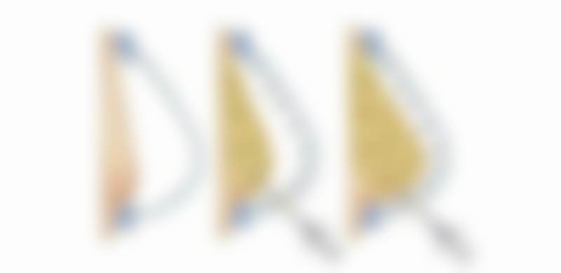 瘢痕整形为何找程超医生?30年修复经验+多技术联合治疗