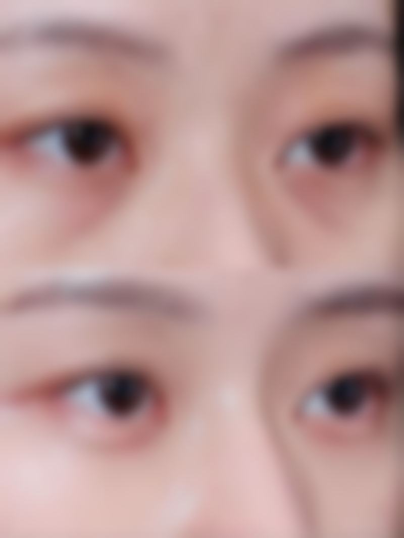 激光治疗下眼袋上的脂肪粒成效如何