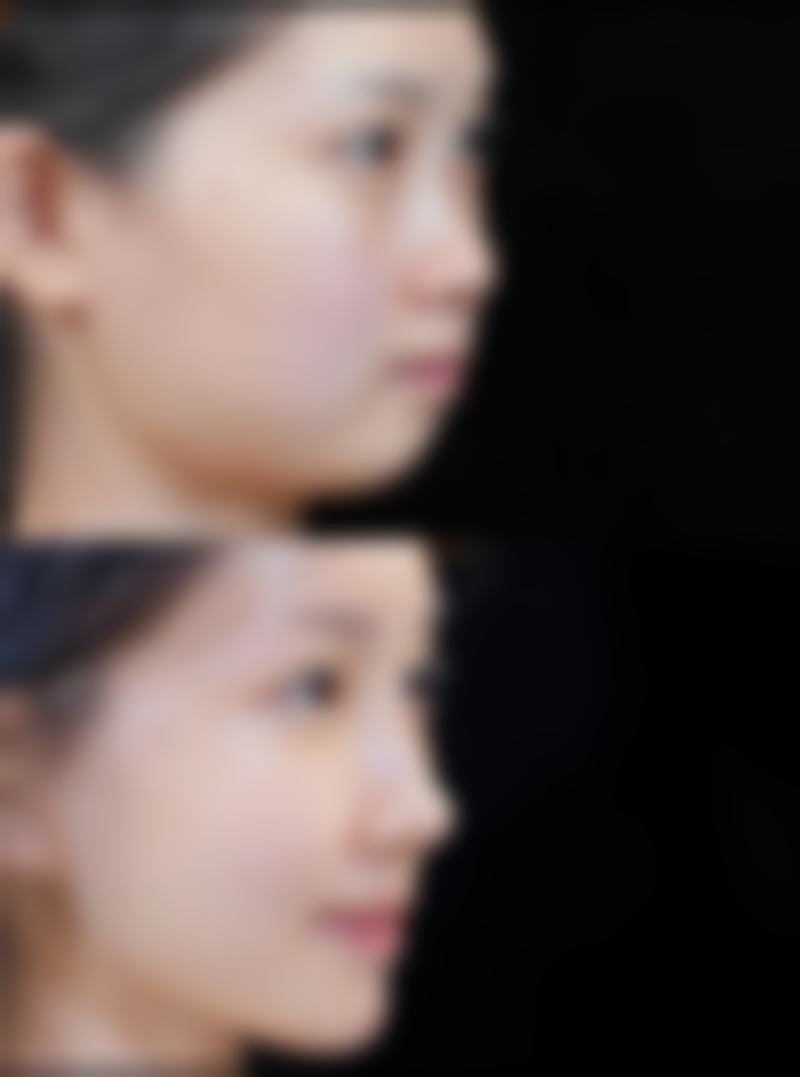 面部smas无痕筋膜提升