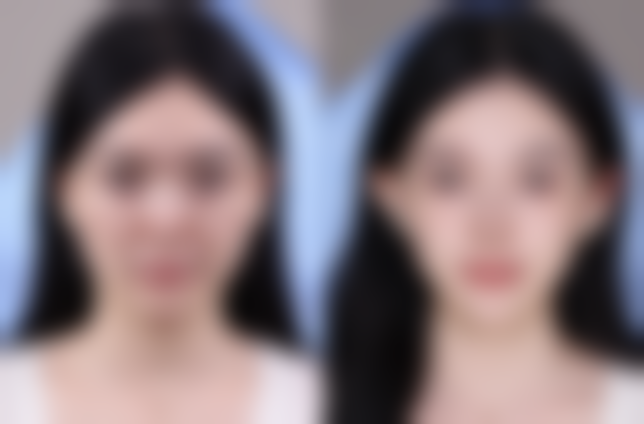 深圳艺星整形成效靠谱吗？真人实例见证自然妈生感