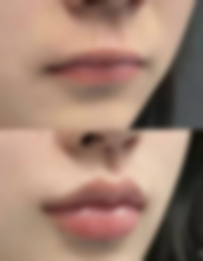 武汉叶子医疗美容医院——厚唇改薄综合实力强