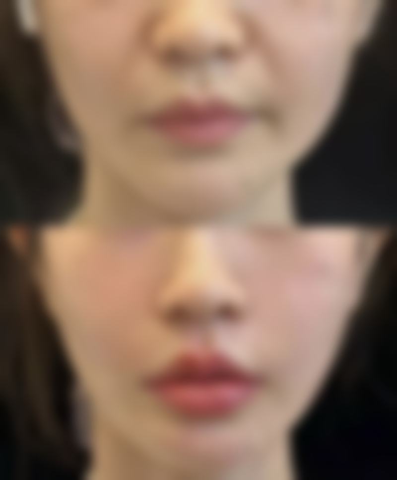 武汉中韩整形美容医院——厚唇改薄专精力量