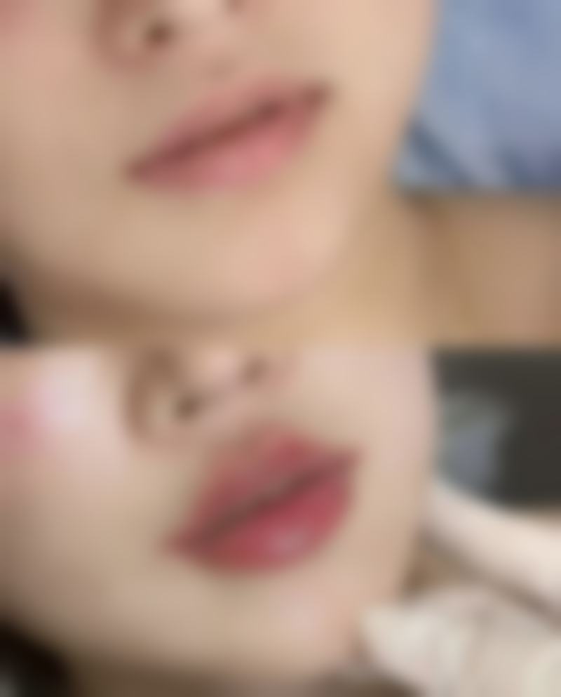 厚唇改薄项目热门问题解答及在线询问