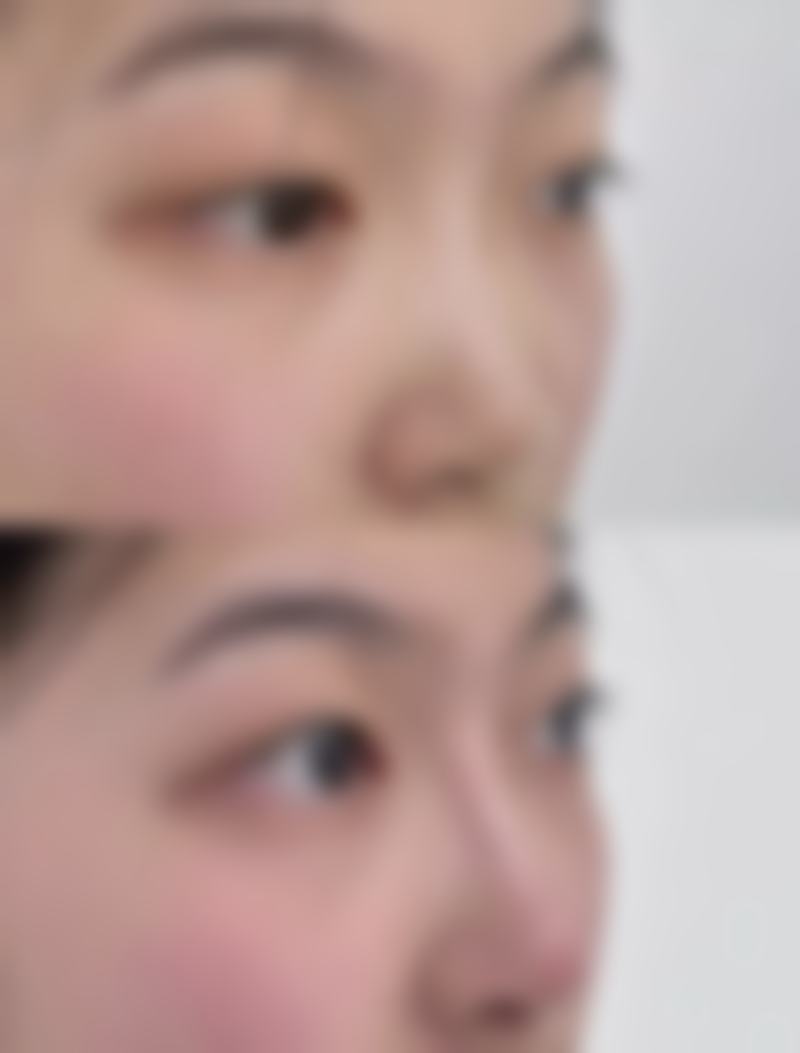 三、隆鼻修复、双眼皮手术成效如何保护？听听三等甲医院靠谱医生怎么说