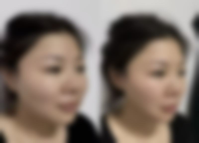 三、双眼皮5000起，肉毒素2000+？佛山市二医院美容价格表大公开！