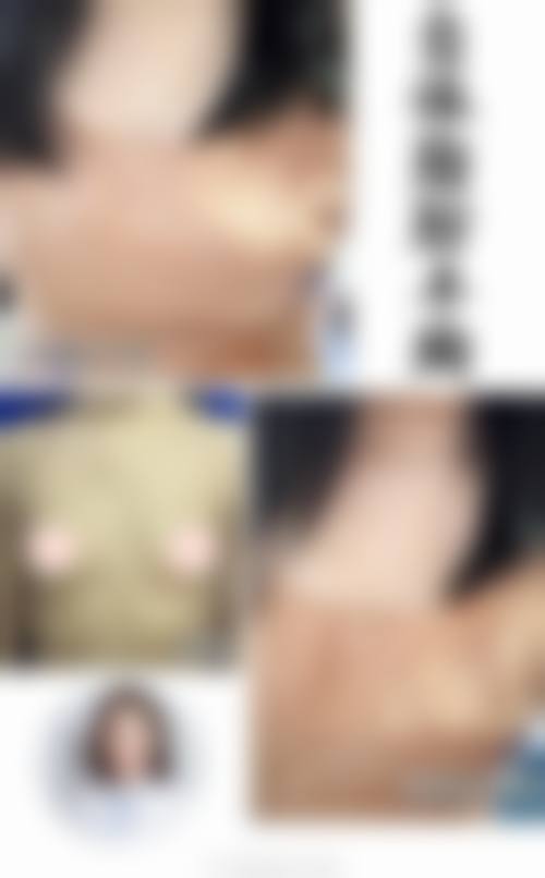 三、天鑫的价格真的那么亲民吗？揭秘双眼皮3000+、玻尿酸3999元的真相