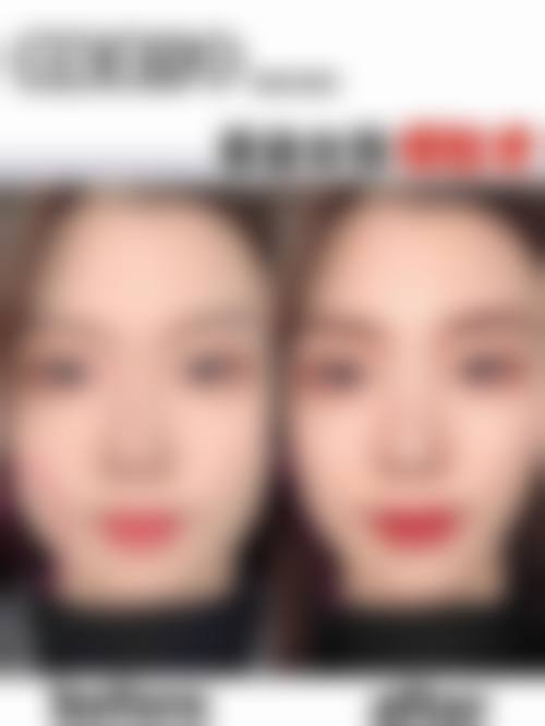 佛山打瘦肩针的骨干医生哪个好预约挂号攻略