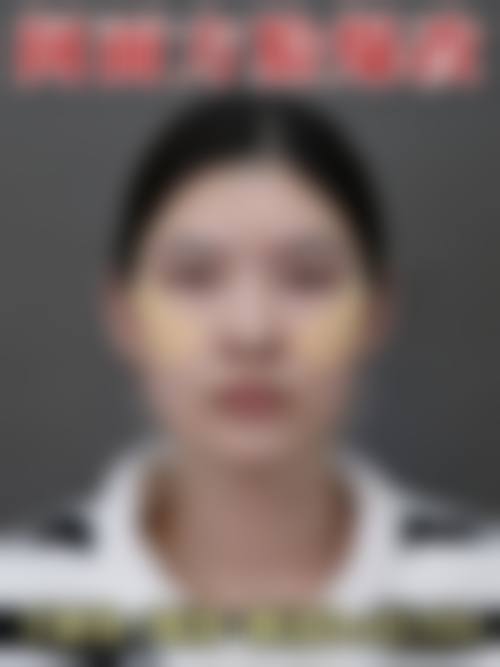 广州颧骨整形骨干医生排名——广州韩妃医疗美容医院柳超医生