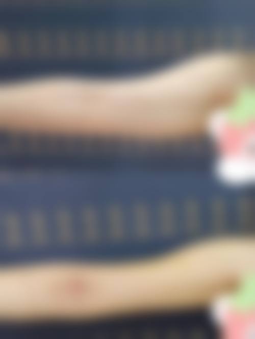 抽脂丰胸是否危险?风险主要集中在哪些环节?