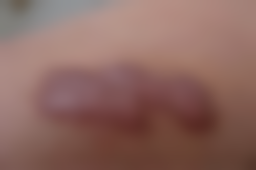 六、2026年武汉手术疤痕修复性价比推荐