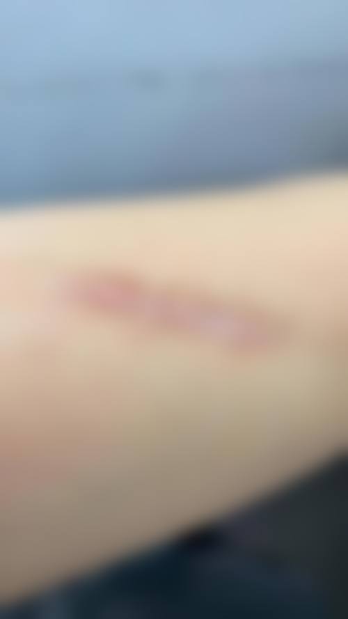 鼻子上的疤痕增生如何消除？激光、手术等多法可选，费用200-20000元不等！ 