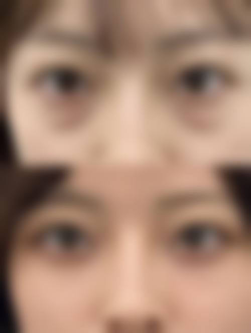 纳米无痕双眼皮做法视频