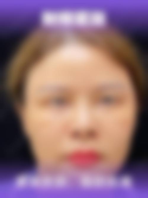 手术治疗去除下眼袋及皱纹