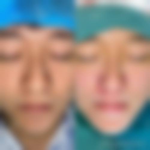 {做完假体耳软骨隆鼻多久可以同房？至少等2周，附消肿时长及饮酒注意事项