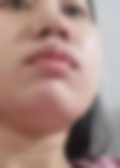 广州做颧骨内推哪个医生有名——崔东医生（广州韩后医疗美容医院）