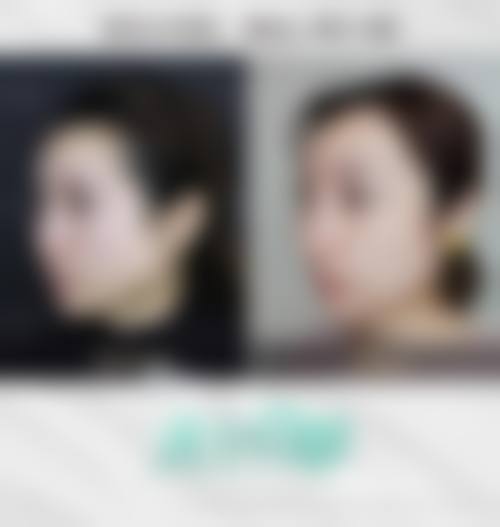 广州看颧骨高哪家医院好预约挂号攻略