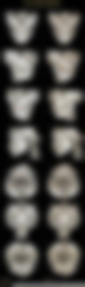 广州广大医院颧骨颧弓手术是怎么做的