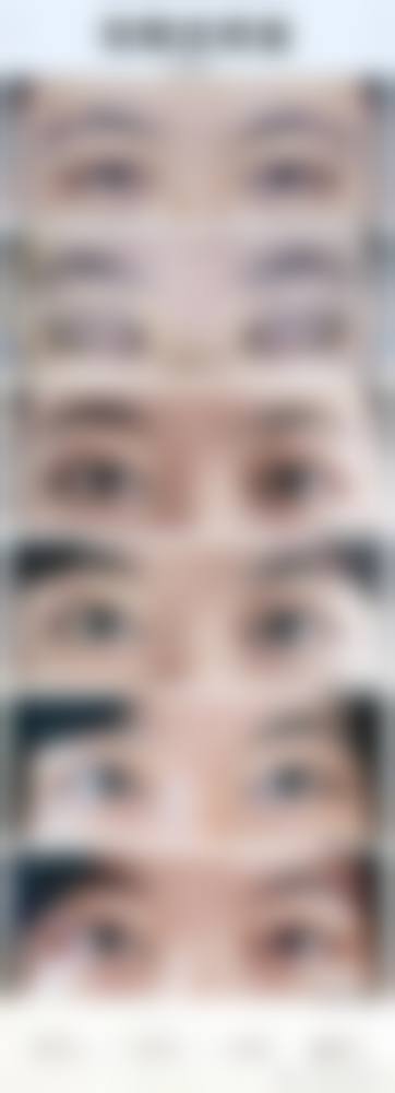 大连爱德丽格眼部整形：金刀奖团队亲诊，项目全成效真实可见