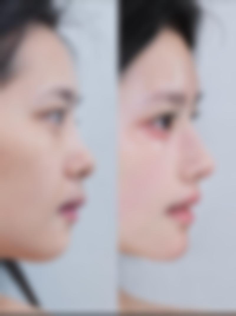 七、做完假体耳软骨隆鼻的费用为何差异明显？价格区间如何形成？