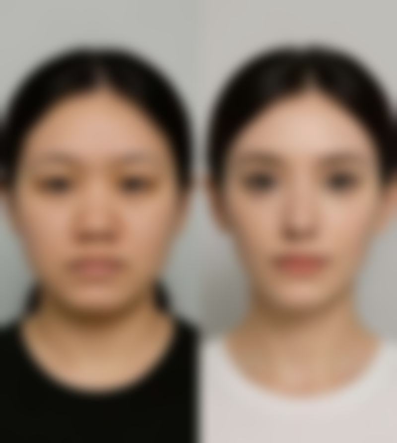 5、成都三等甲医院做拉皮手术——成都西区医院整形科