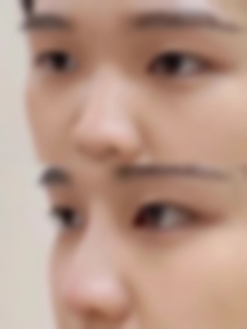 5. 隆胸整形 - 国产假体隆胸（10500元起步）