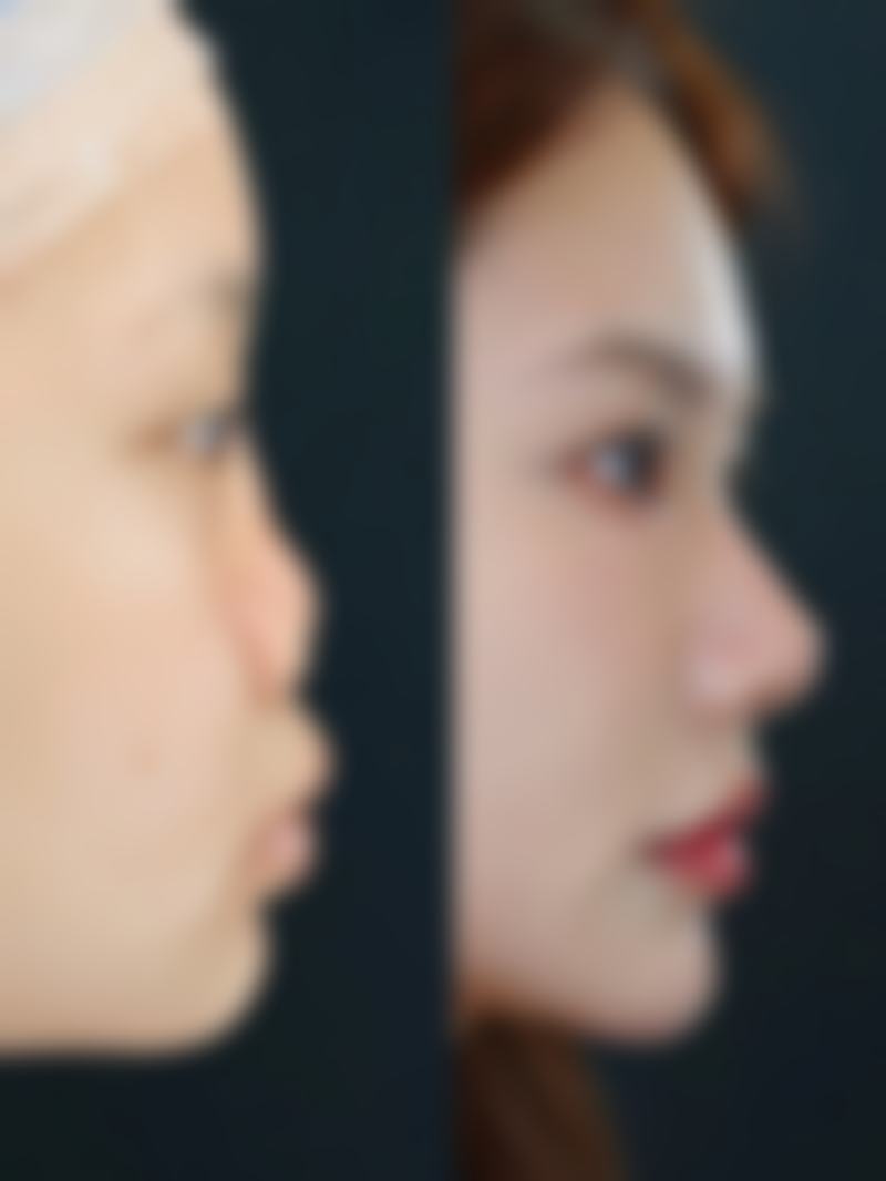 4. 眼部整形 - park动态美眼综合手术（4000元起步）