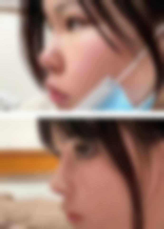 激光治疗：上海九院改善鼻子增生性凸疤痕