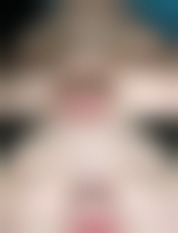 纳米无痕双眼皮操作全过程