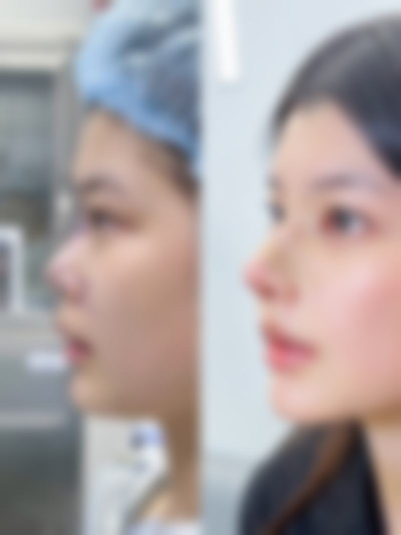 三、从医学角度看，做完假体耳软骨隆鼻多久可以同房的核心目的是什么？