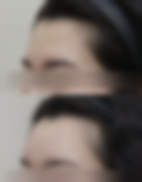 三、做双眼皮,找甘肃省人民医院靠谱吗?成效自然吗?