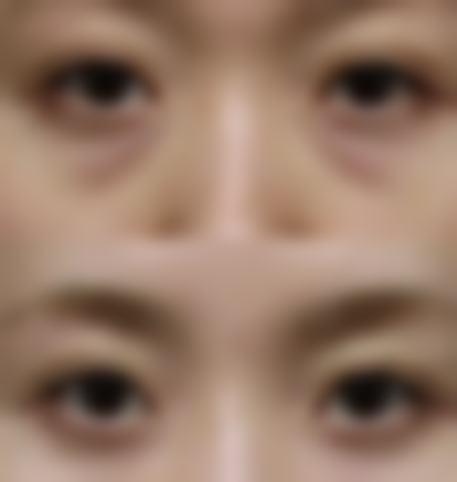 {疤痕体质用什么线缝合不留疤痕？选可吸收美容线！生物相容性好/无需拆线/瘢痕更细微