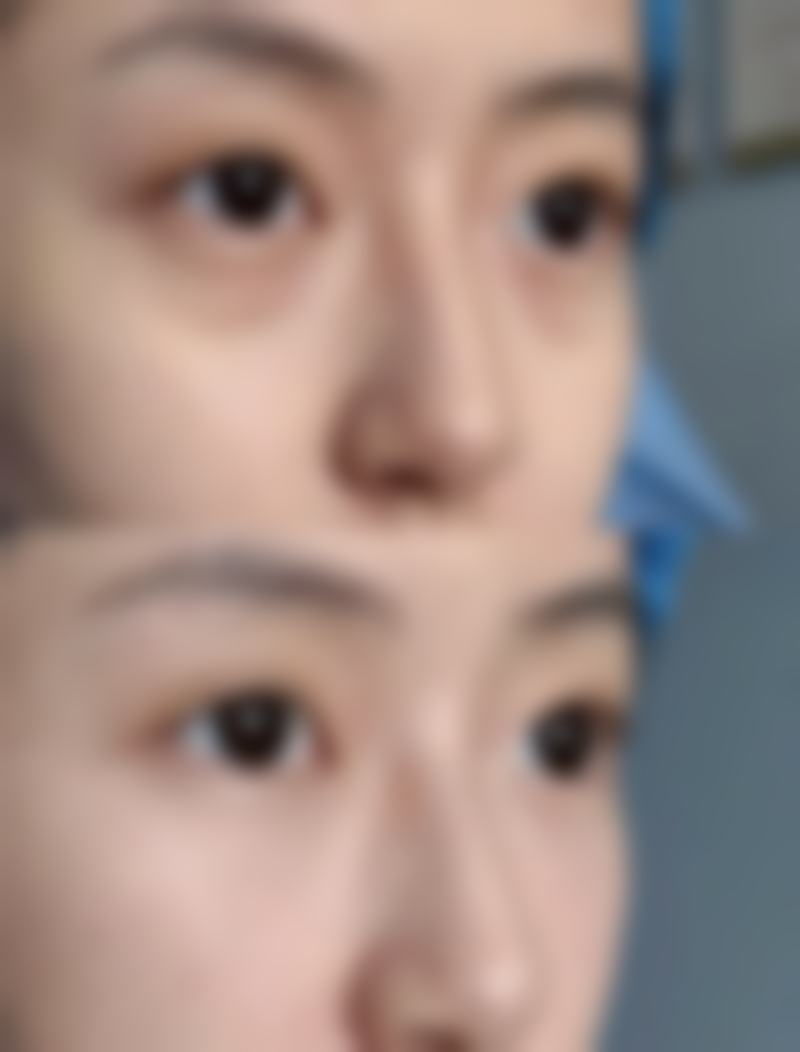 无痕双眼皮价格区间及费用差异来源