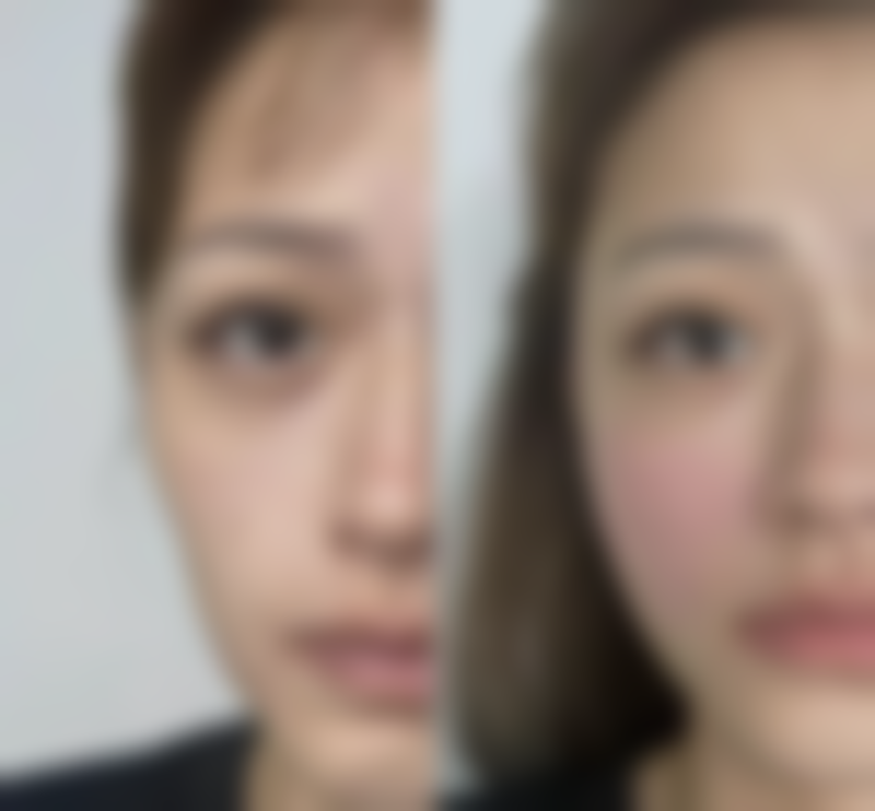 光子嫩肤治疗哭肿眼袋的成效与风险