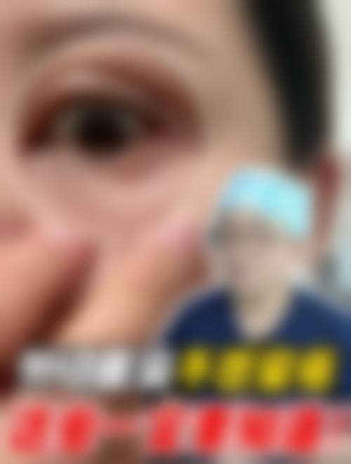 其他手术祛眼袋方法大盘点