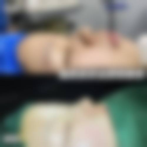 线提升隆鼻的优缺点有哪些