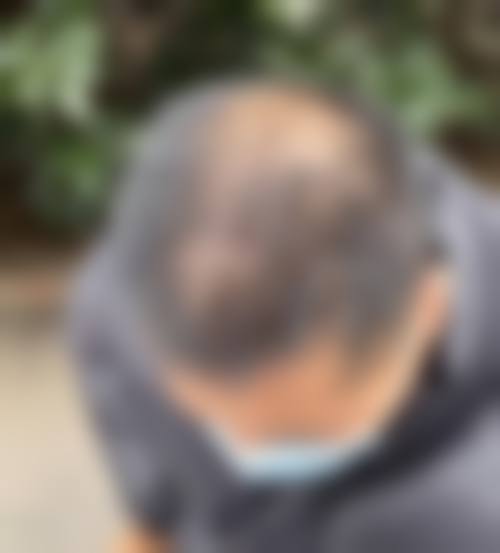 面部受伤留下疤痕赔偿的影响因素