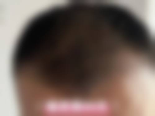 面部受伤留下疤痕赔偿的价格区间及费用差异来源