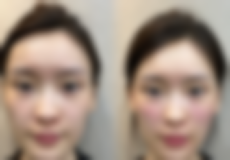 面部受伤留下疤痕赔偿在什么医学背景下被选择