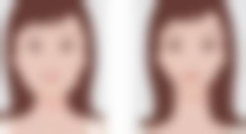 {Botox除皱的效果怎么样？维持4 - 6个月，单部位1000 - 3000元，副作用多数可自行恢复！ 