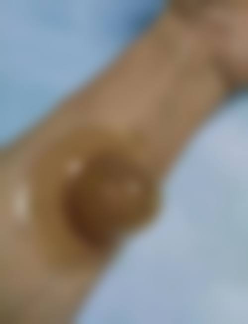 取出隆胸假体的影响因素