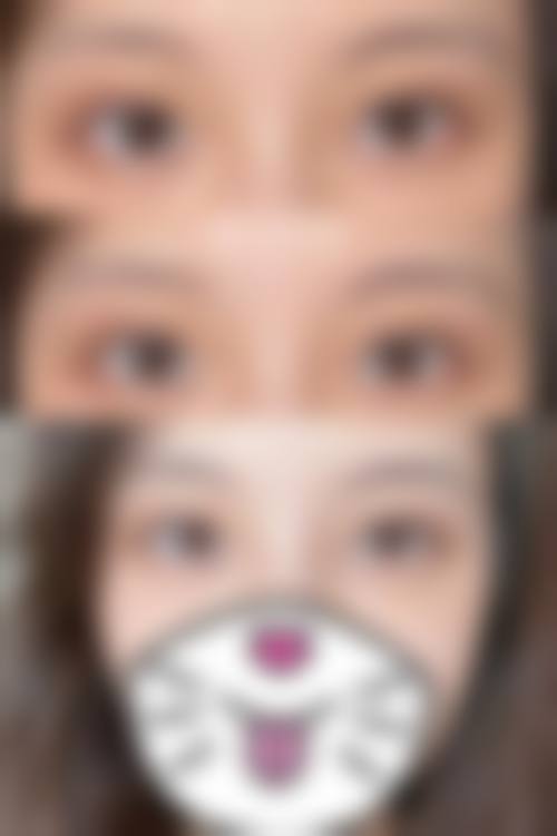 哪些人群在评估中更可能被建议考虑双眼皮手术？