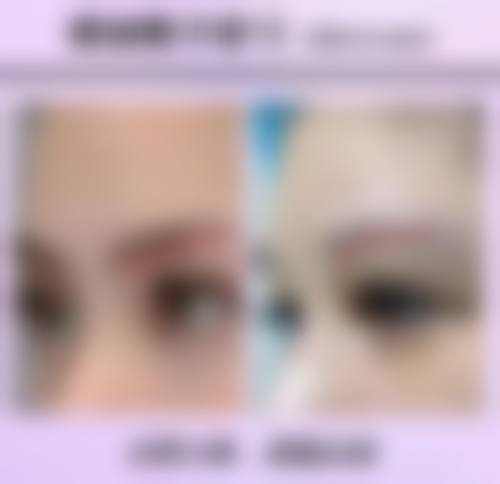 双方都是双眼皮孩子单眼皮能变双眼皮吗