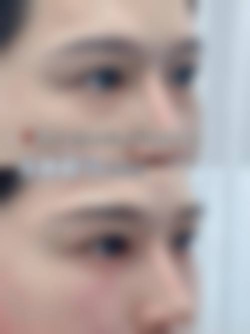 从医学角度看，双眼皮手术的风险主要集中在哪些环节？