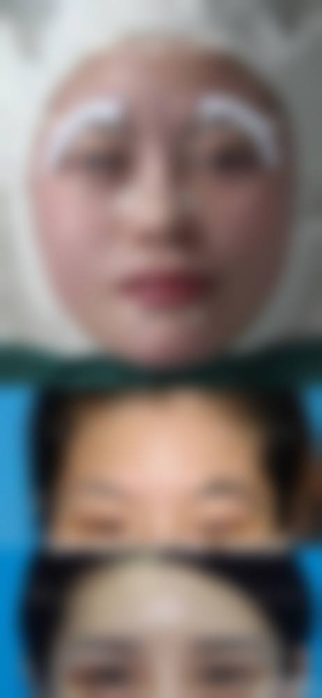 双眼皮手术的常见认知偏差与误解