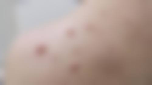 治疗凹陷疤痕至佳的时间是什么时候？药膏使用的黄金期