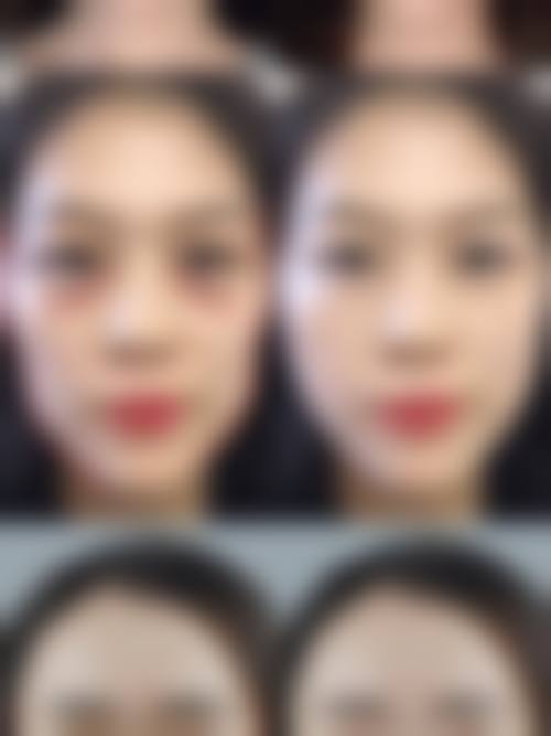 做完双眼皮怎样才能修复的更好不留疤？