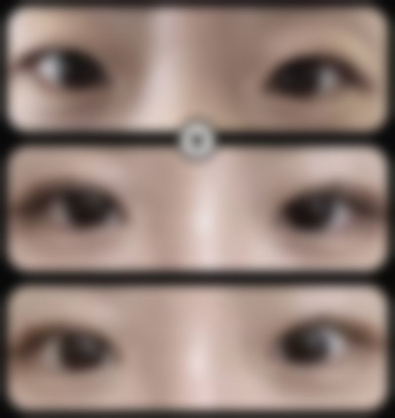 如何判断自己是否适合双眼皮手术？