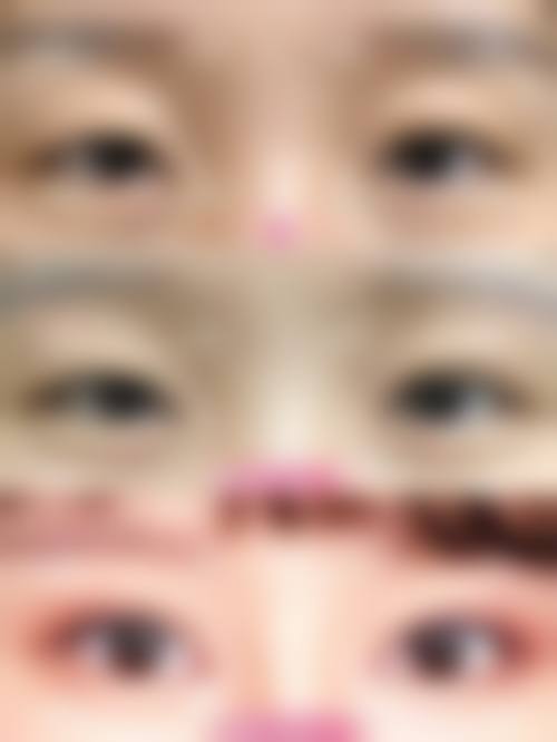 西安张沙沙五层组织复位术修复闭眼也是双眼皮的技术优势在哪？