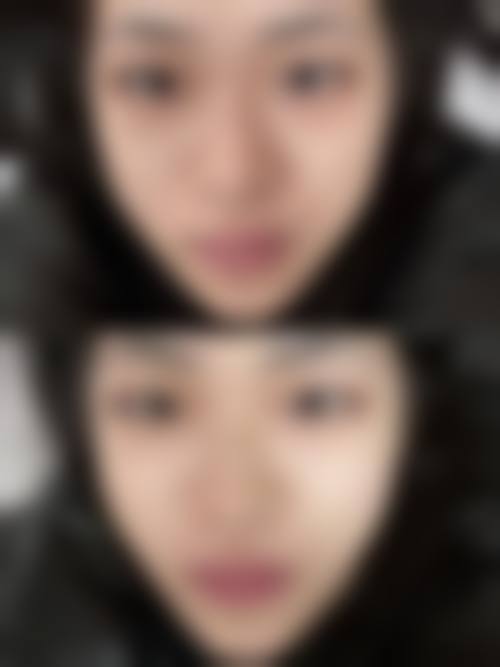 西安张沙沙医生修复闭眼也是双眼皮有哪些成功实例？